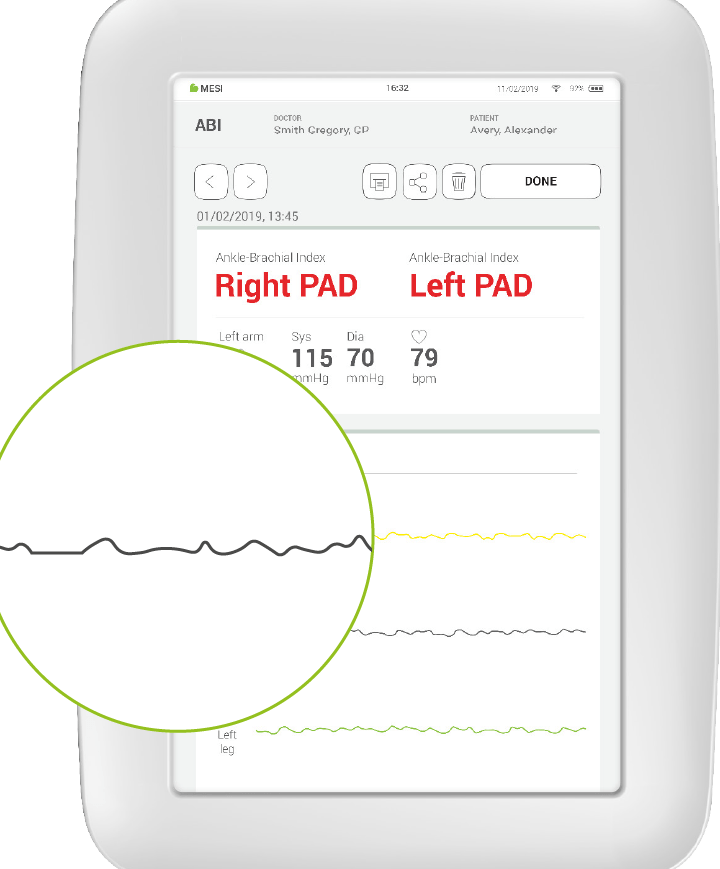 Calculadora de ABI (índice tobillo-brazo) Índice de presión tobillo-brazo (ABPI) |
