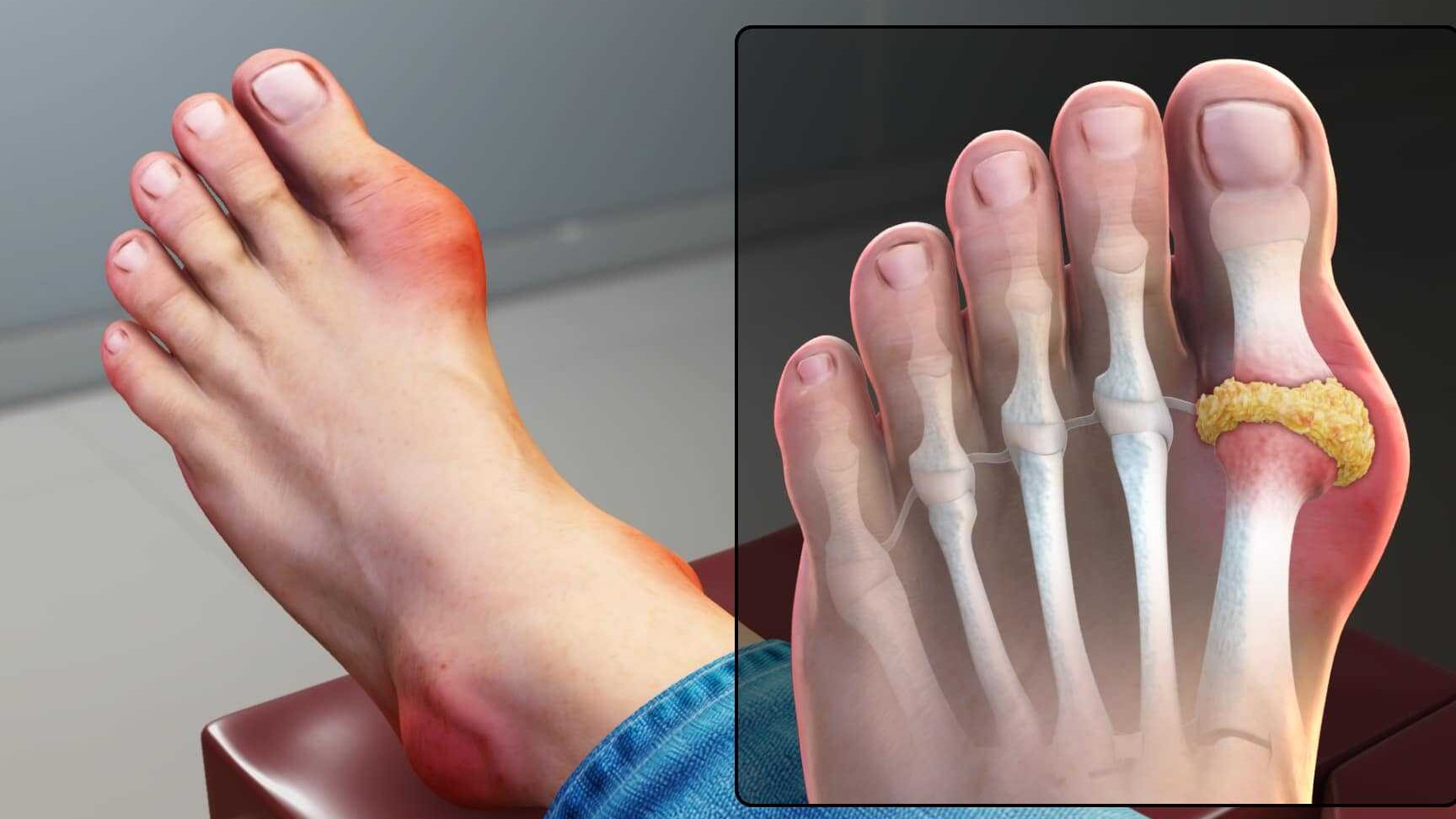 Gota Discapacidad VA |