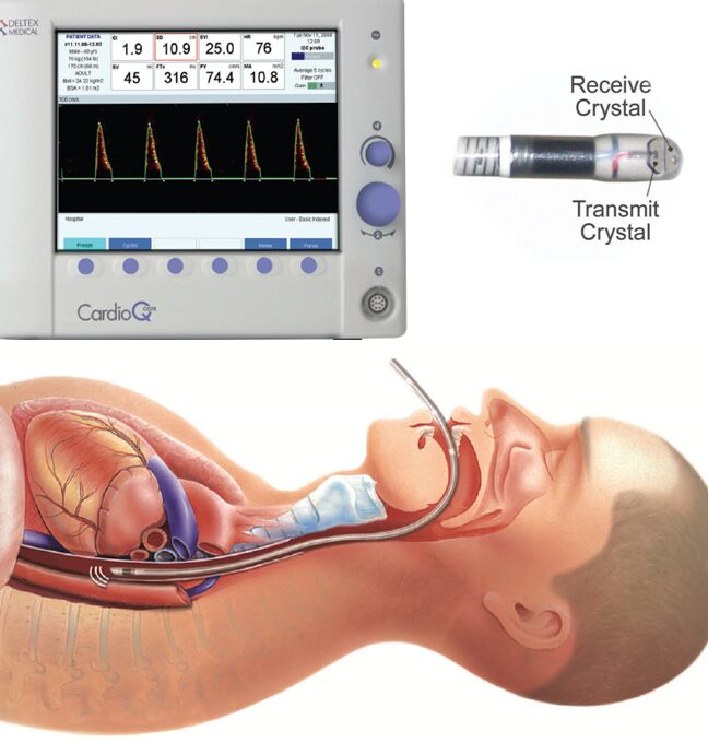 Cálculo del volumen sistólico.