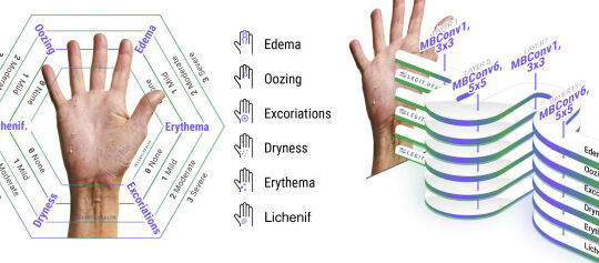 Índice de puntuación de gravedad de la dermatitis atópica (SCORAD)